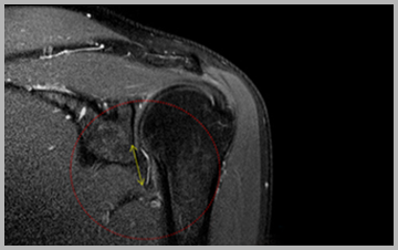염증에 의해 유착된 어깨 관절낭 MRI 영상