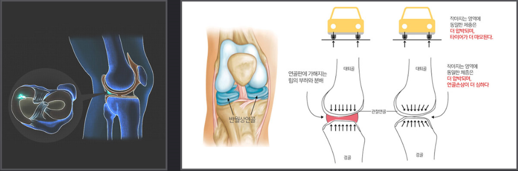 반월상 연골판의 위치와 무릎에 가해지는 체중 부하를 설명하는 일러스트