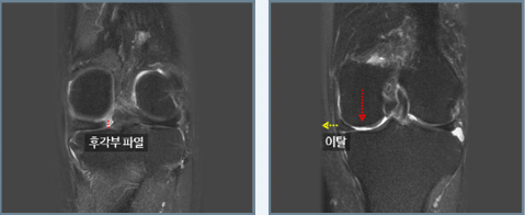 후각부 파열과 연골판 이탈을 표시한 무릎 MRI 영상