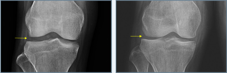 연골판 제거 전후 무릎 X-ray 비교: 제거 후 관절면 높이 감소