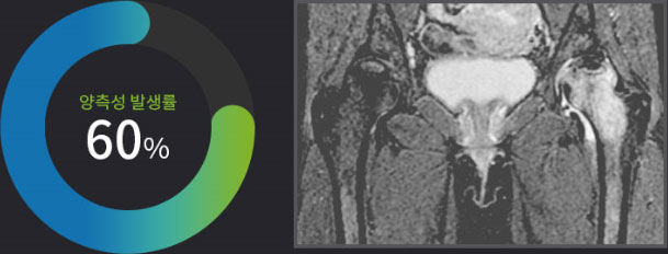 대퇴골두 무혈성 괴사 양측성 발생률 60%와 양쪽 고관절 MRI 영상