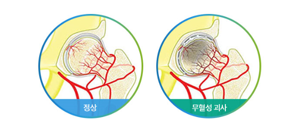 정상 대퇴골두와 혈류가 차단된 무혈성 괴사 대퇴골두 혈관 비교 일러스트