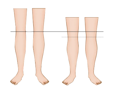 두 다리의 길이를 기준선과 비교한 하지 일러스트