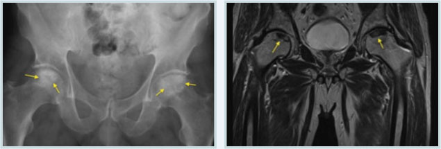 고관절 병변을 화살표로 표시한 골반 X-ray와 MRI 영상