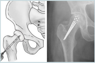 중심 감압술 모식도와 핀이 삽입된 고관절 X-ray 영상