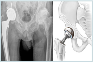 인공관절치환술 후 고관절 X-ray와 인공관절 삽입 모식도