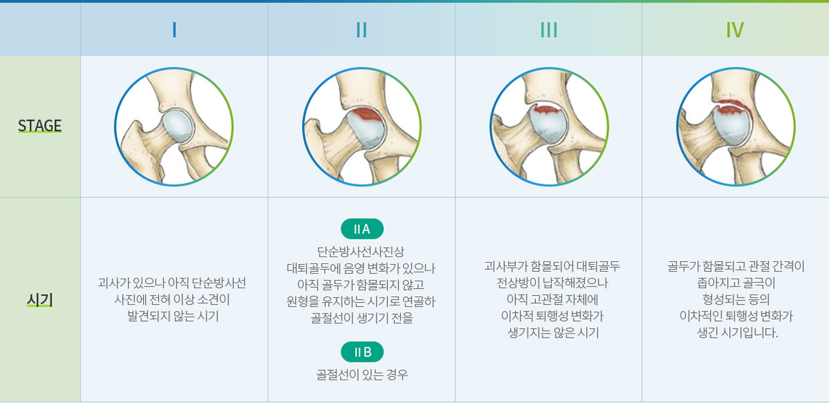 무혈성 괴사 1기부터 4기까지 병기별 대퇴골두 변화와 시기 설명