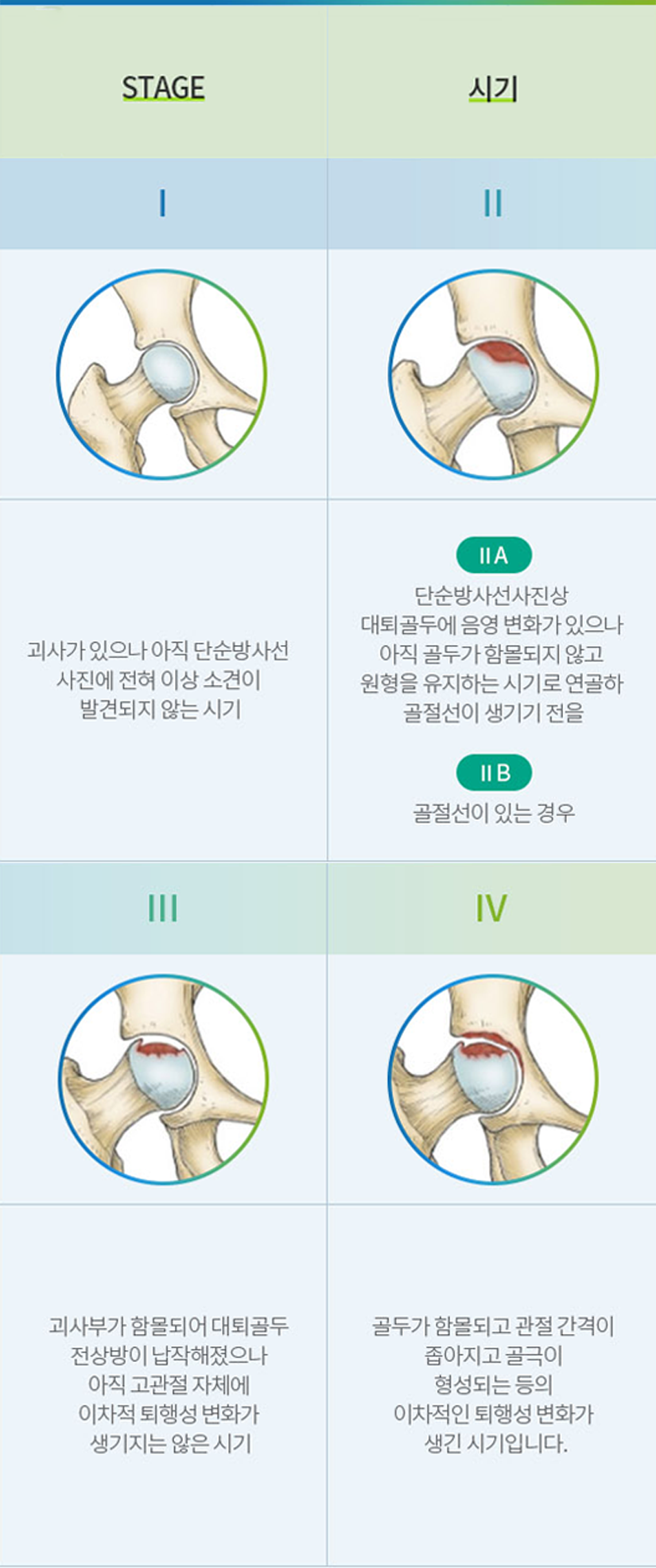 무혈성 괴사 1기부터 4기까지 병기별 대퇴골두 변화와 시기 설명