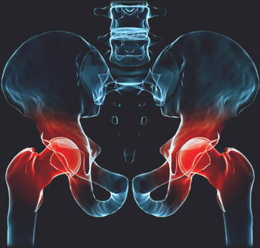 통증 부위를 붉게 표시한 고관절 X-ray 일러스트