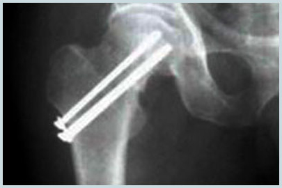 나사로 고정한 고관절 골절 X-ray 영상