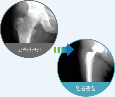 고관절 골절 X-ray와 인공관절 치환술 후 X-ray 영상