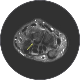 손목 수근관 단면 MRI 영상