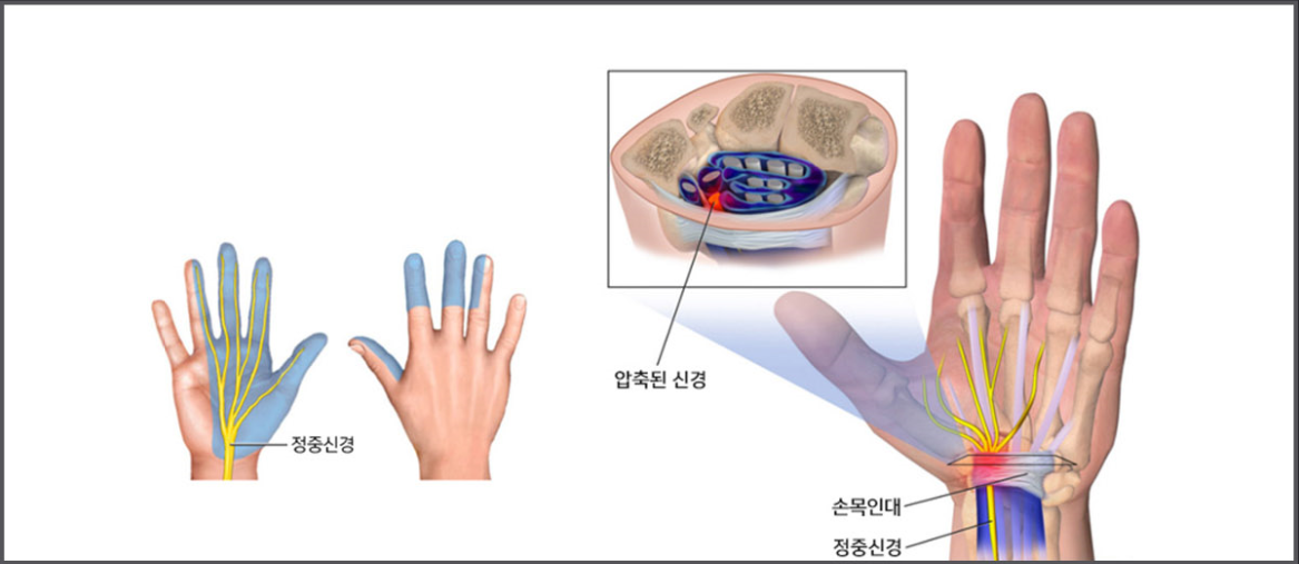 손목 수근관 안에서 정중신경이 눌리는 모습을 보여주는 해부 일러스트