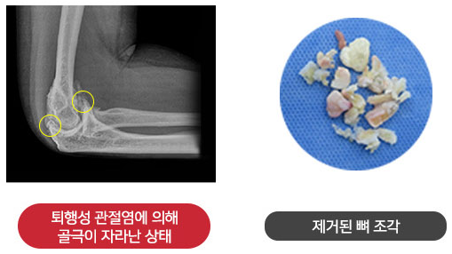 퇴행성 관절염으로 골극이 자란 팔꿈치 X-ray와 제거된 뼈 조각
