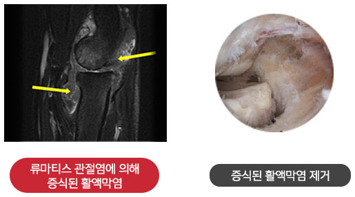 류마티스 관절염으로 증식된 활액막 MRI와 활액막 제거 관절내시경 화면