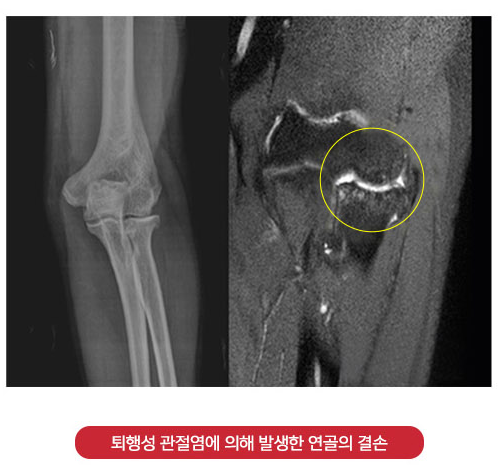 퇴행성 관절염으로 연골이 결손된 팔꿈치 X-ray와 MRI 영상