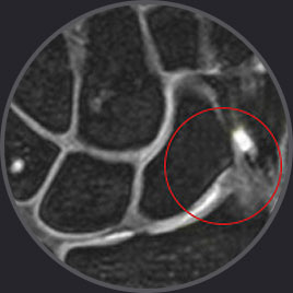 손목건초염 부위를 붉은 원으로 표시한 손목 MRI 영상