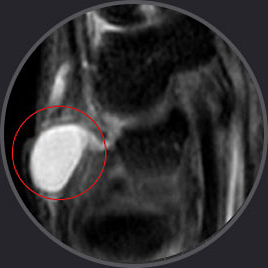 손목 결절종(물혹)을 붉은 원으로 표시한 MRI 영상