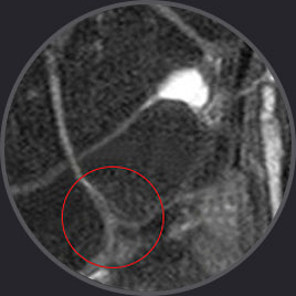 삼각연골복합체 손상 부위를 붉은 원으로 표시한 손목 MRI 영상