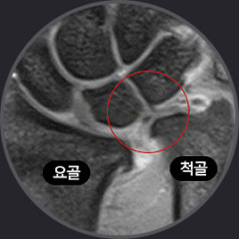 요골과 척골 사이 척골충돌 부위를 표시한 손목 MRI 영상
