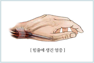 엄지 쪽 손목 힘줄에 생긴 염증을 나타낸 손 일러스트