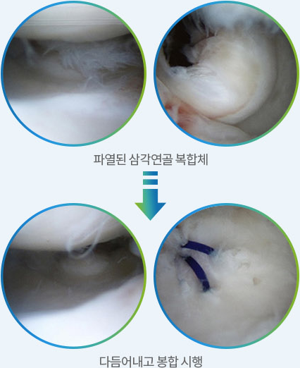 파열된 삼각연골복합체를 다듬고 봉합하는 관절내시경 화면