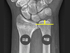 요골보다 척골이 긴 상태를 표시한 손목 X-ray 영상