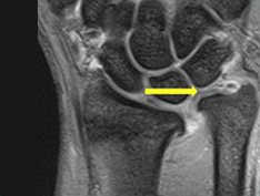 척골충돌로 삼각연골복합체가 파열된 손목 MRI 영상