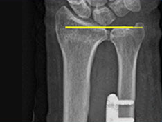 척골 단축술 후 금속판으로 고정한 손목 X-ray 영상