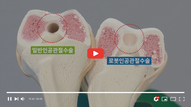 '로봇인공관절수술 &일반인공관절수술' 차이점을 확실하게!!보여드립니다.