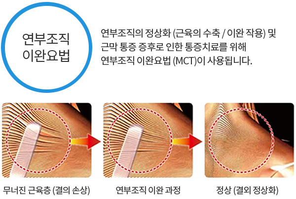 연부조직 이완요법 설명, 무너진 근육층이 이완 과정을 거쳐 정상화되는 모습
