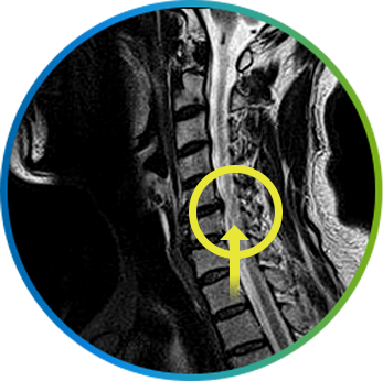 목디스크 부위를 표시한 경추 MRI 측면 영상