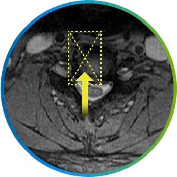 목디스크가 신경을 누르는 부위를 표시한 경추 MRI 단면 영상