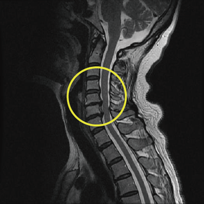 인공디스크 수술 전 경추 MRI 영상
