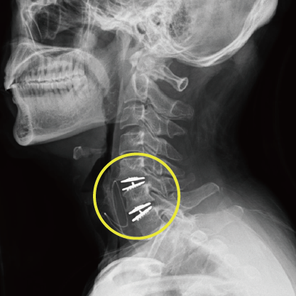 인공디스크 수술 후 경추 X-ray 영상