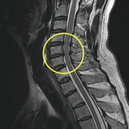 척추체 감압술 전 경추 MRI 영상