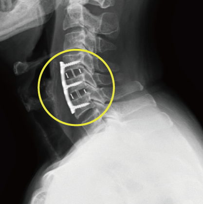 척추체 감압술 후 케이지와 고정물이 보이는 경추 X-ray 영상