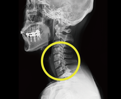 경추 측면 X-ray 영상, 목뼈 부위 표시