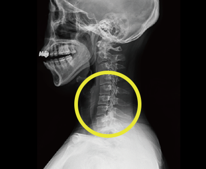 일자목 확인을 위한 경추 측면 X-ray 영상