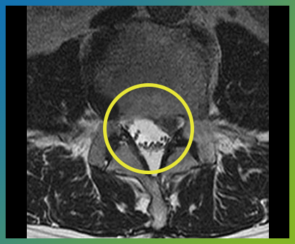 허리디스크가 신경을 누르는 부위를 표시한 요추 MRI 단면 영상