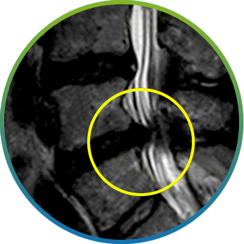 척추관 협착 부위를 원으로 표시한 요추 MRI 확대 영상