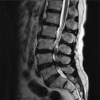 수술 전 요추 MRI 영상