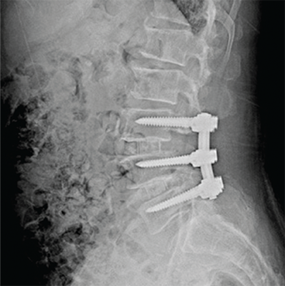 수술 후 나사못으로 고정한 요추 X-ray 영상