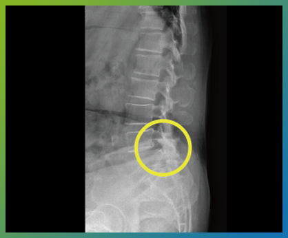 척추전방전위증 부위를 표시한 요추 측면 X-ray 영상