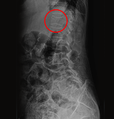 치료 전 요추 X-ray 영상, 압박골절 부위 원 표시