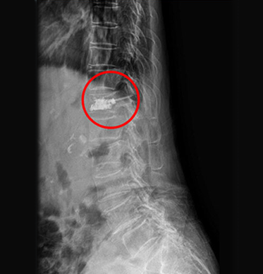 치료 후 요추 X-ray 영상, 시술 부위 원 표시